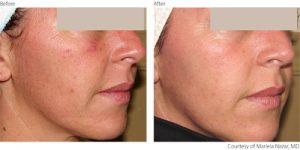 beforeafter1-photorejuvenation-courtesy-of-mariela-nazar-m-d